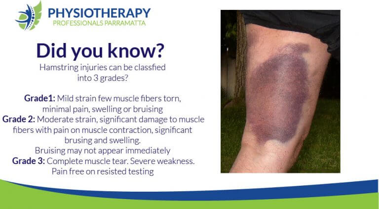 symptoms-of-a-torn-hamstring-how-to-treat-it-torn-hamstring